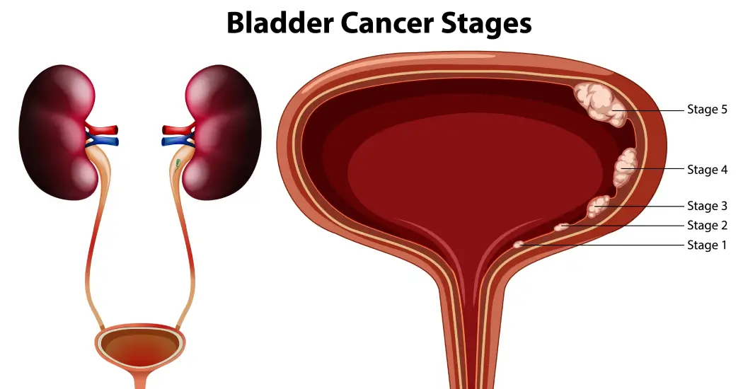 Types of Kidney Stones