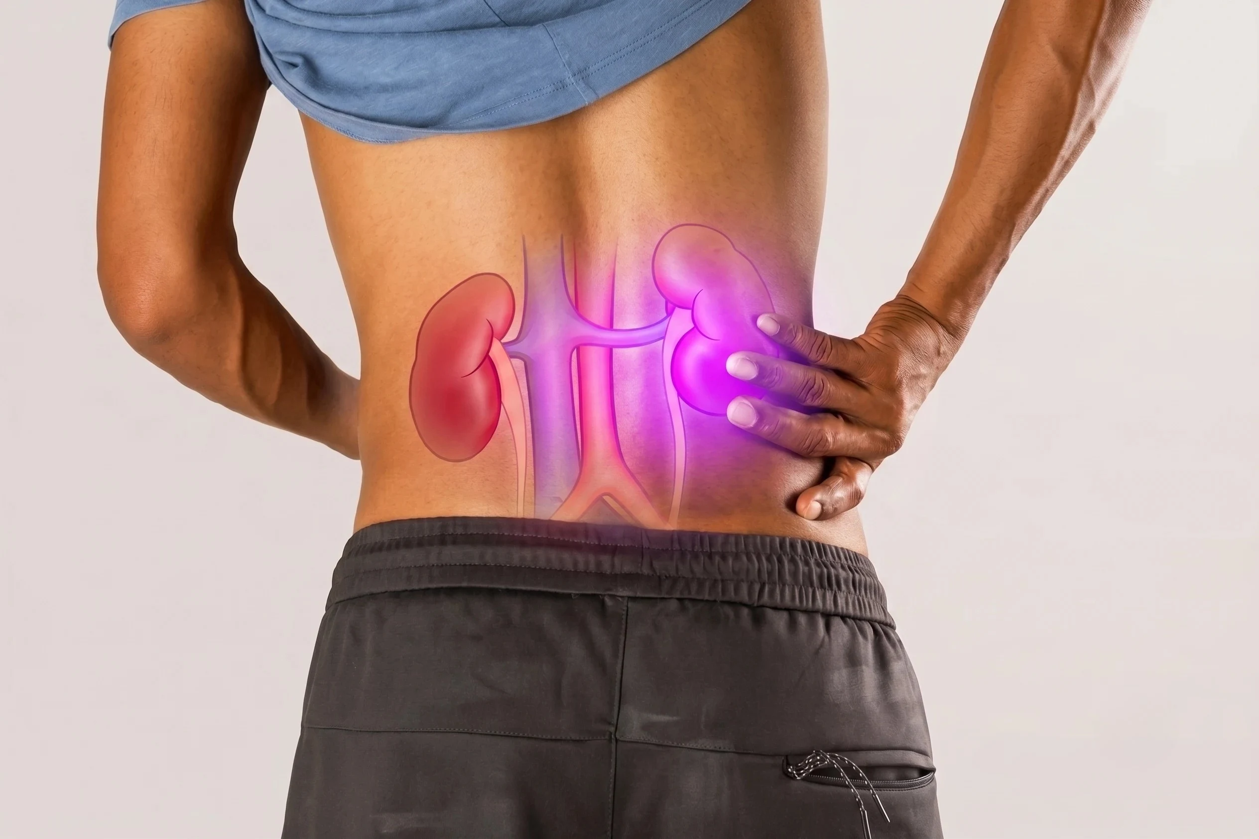 What Happens If a Kidney Stone Is Left Untreated?