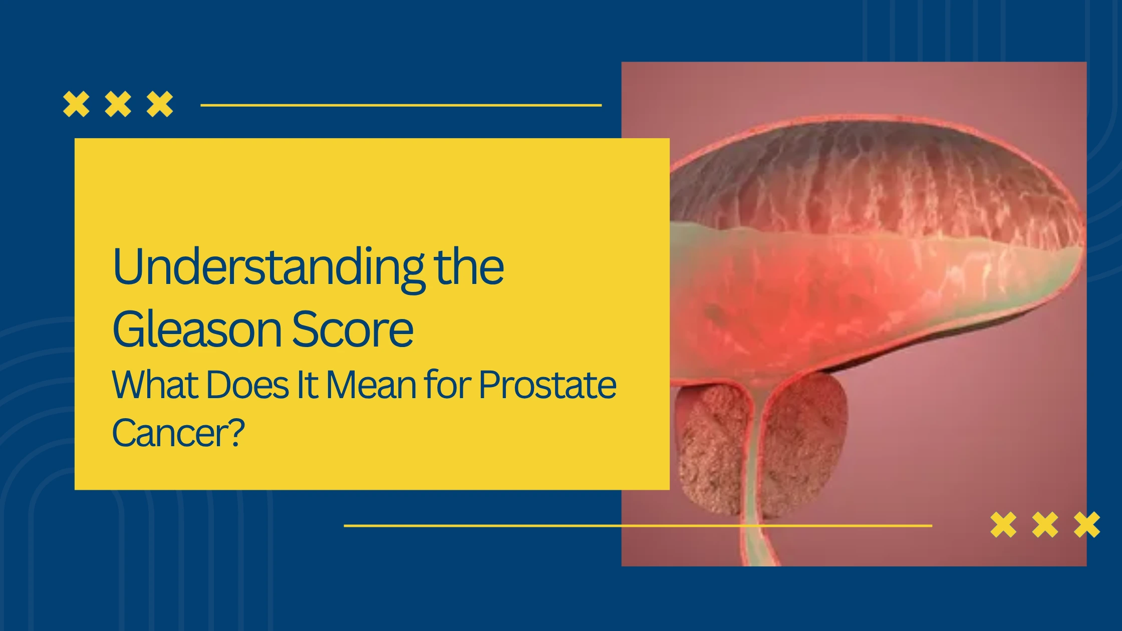Understanding the Gleason Score: What Does It Mean for Prostate Cancer?