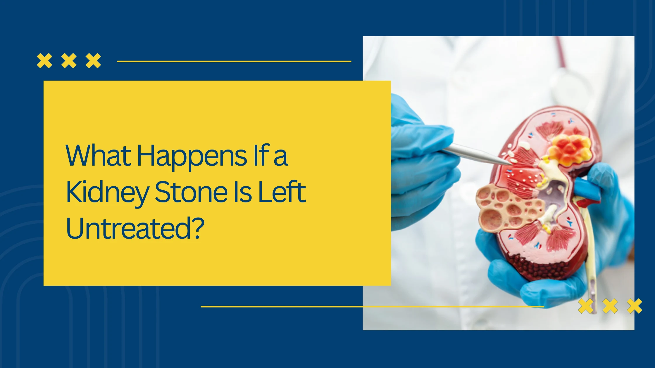 What Happens If a Kidney Stone Is Left Untreated?