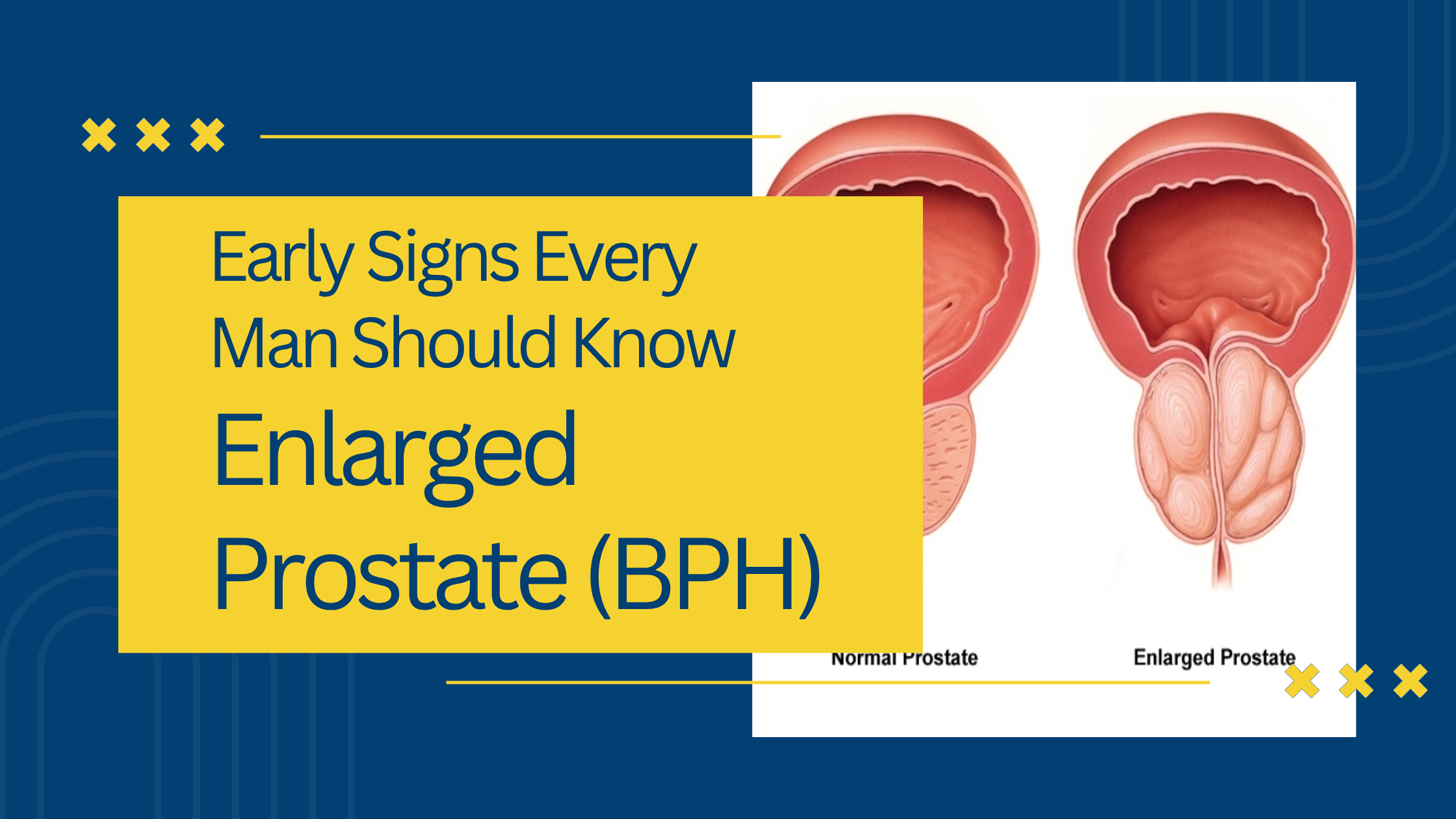 Enlarged Prostate (BPH): Early Signs Every Man Should Know
