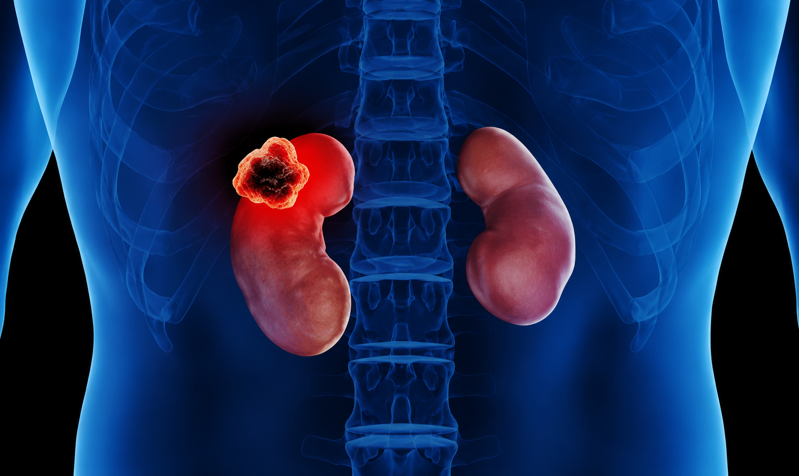 Kidney Cancer Treatment in Navi Mumbai