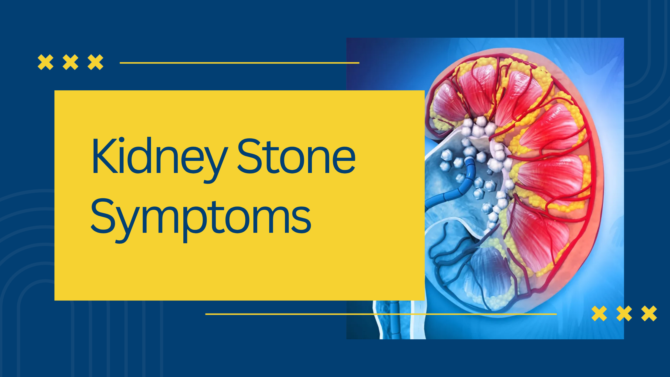 Kidney Stone Symptoms You Should Never Ignore