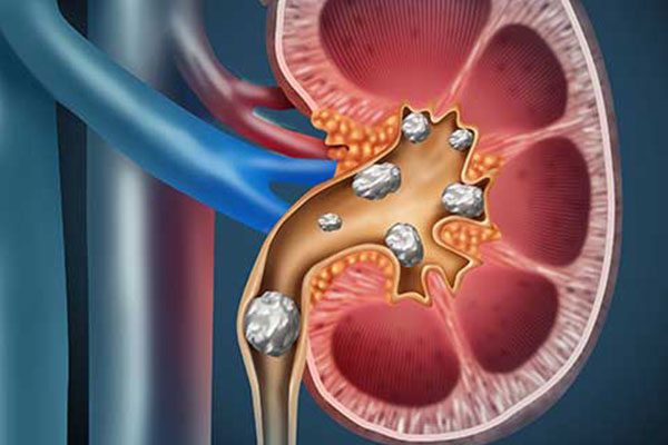 Best Urinary Tract Infection With Renal Stone Treatment at MITR Urology Associates and Hospital in Navi Mumbai, with centres at Panvel, Kharghar, Ulwe, and Vashi.