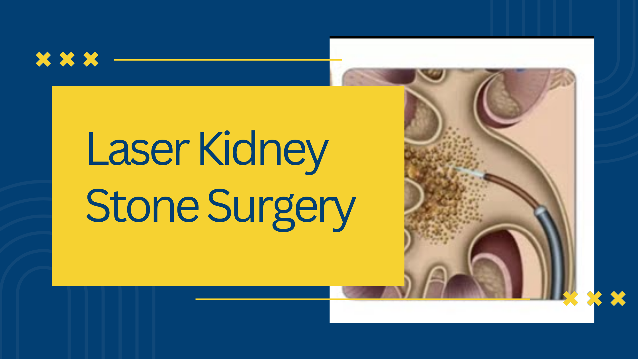 Laser Kidney Stone Surgery: Procedure, Recovery & Benefits