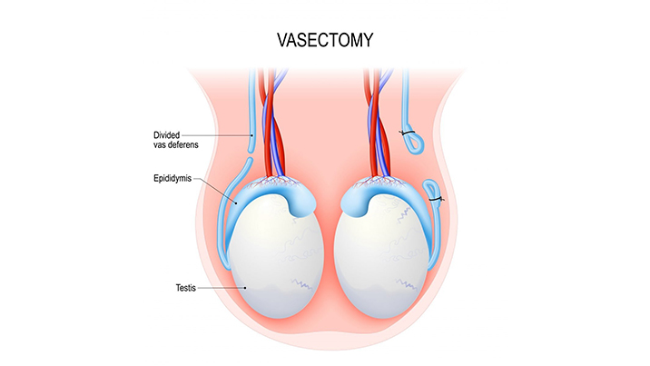 Vasectomy - Treatments Urology Associates