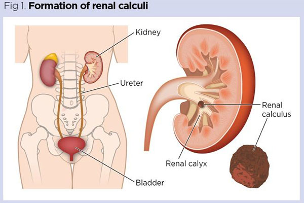 Best treatment for Urinary Tract Infection With Renal Stone at MITR Urology Associates and Hospital in Navi Mumbai, with centres at Panvel, Kharghar, Ulwe, and Vashi.