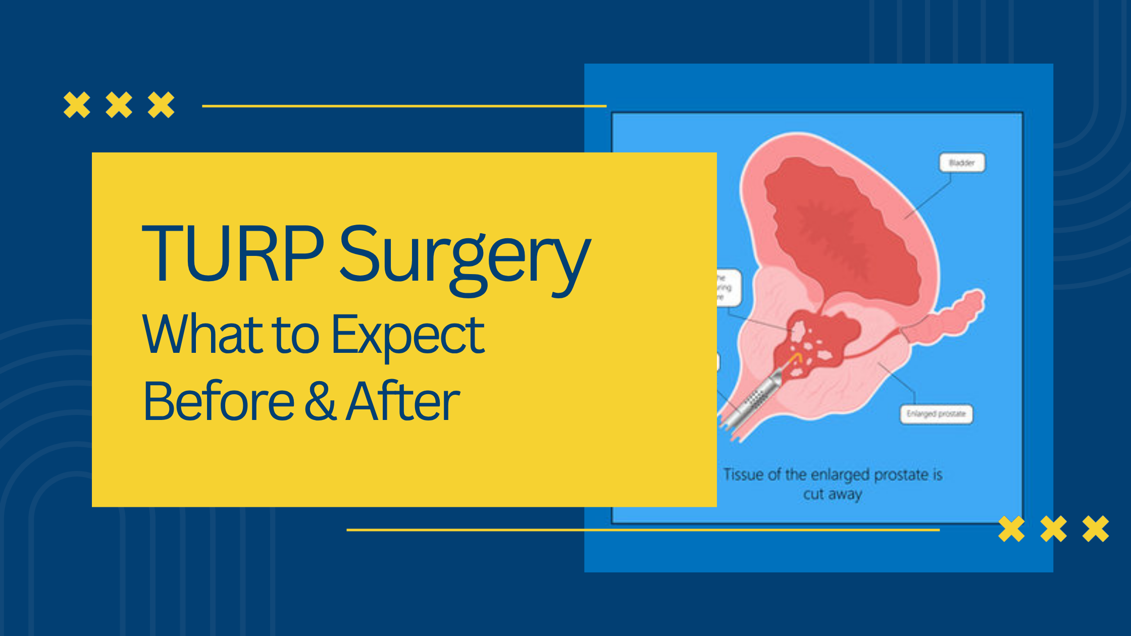 TURP Surgery Explained: What to Expect Before & After